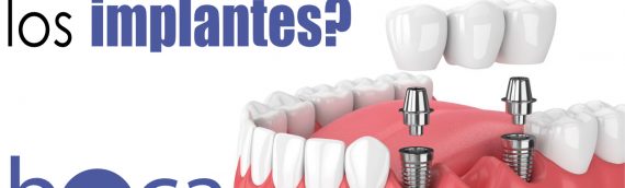 Implantes Dentales
