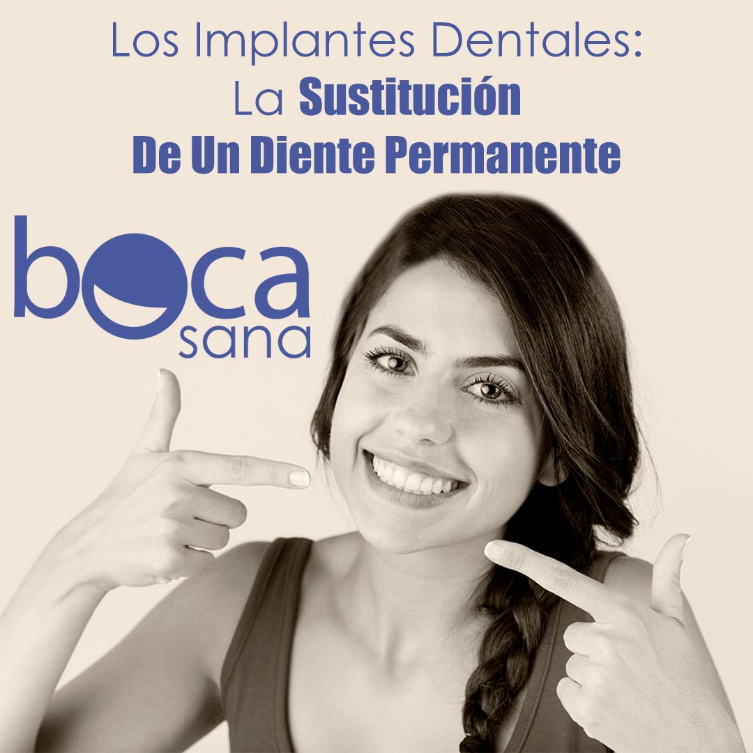 Los Implantes Dentales: La Sustitución De Un Diente Permanente A Considerarse