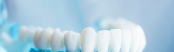 IMPLANTES DENTALES Y CUIDADO