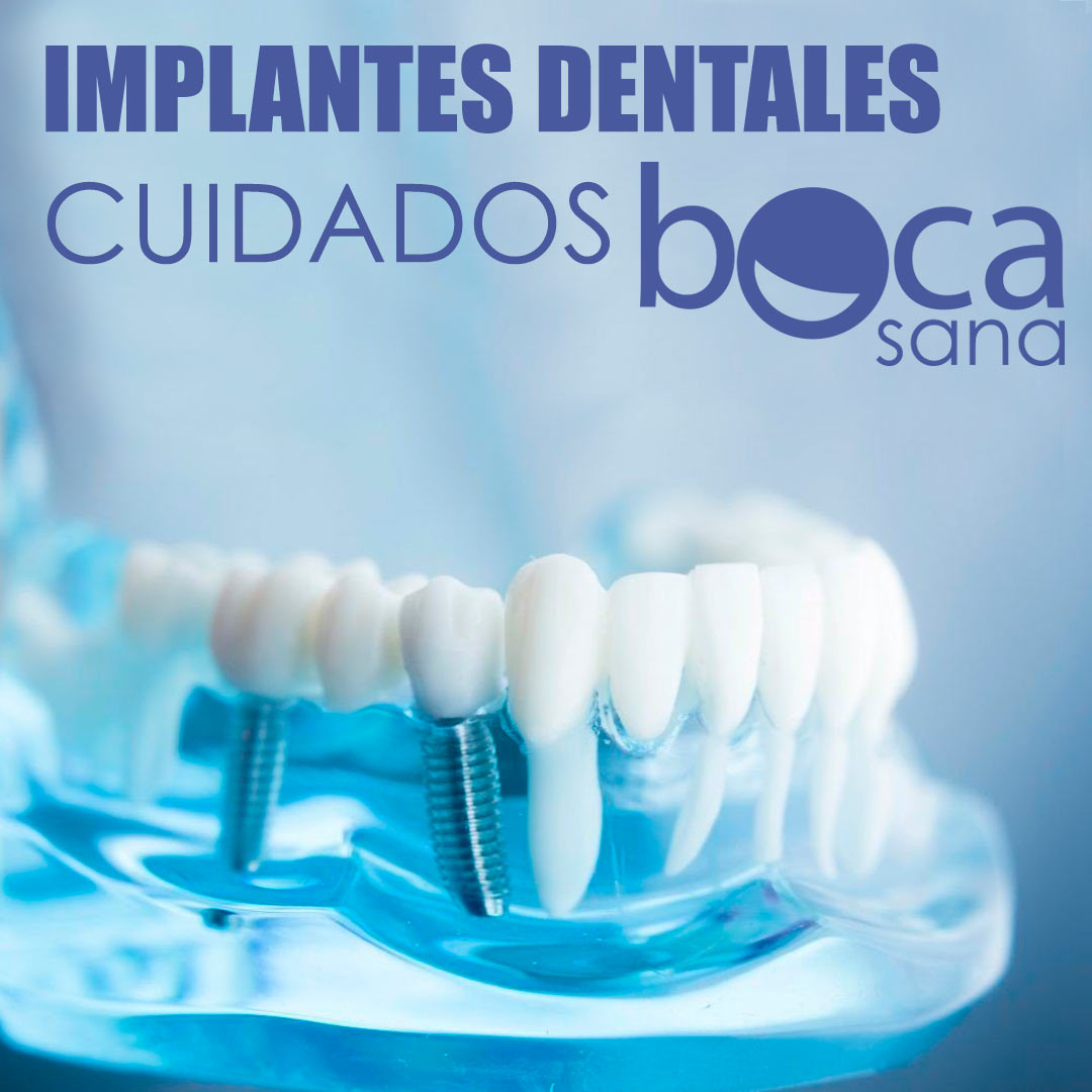 IMPLANTES DENTALES Y CUIDADO