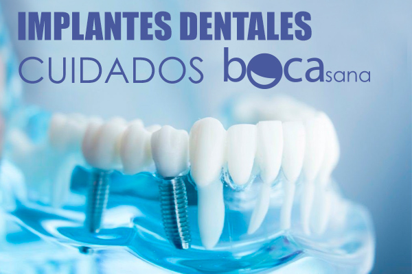 IMPLANTES DENTALES Y CUIDADO