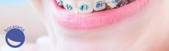 Brackets como funcionan