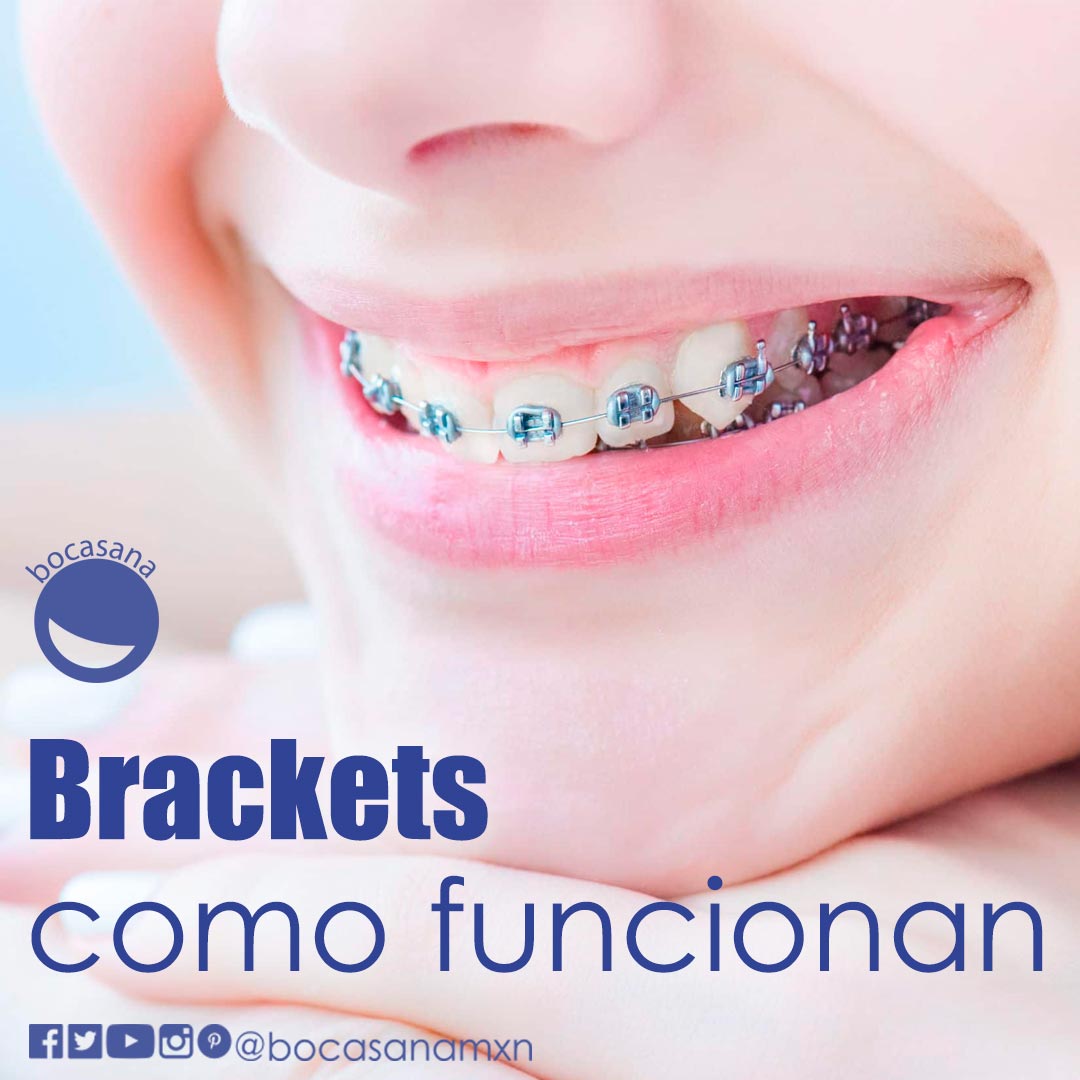 Brackets como funcionan