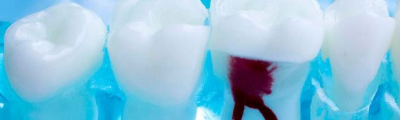 Por que es importante la endodoncia?  – Consultorios BocaSana