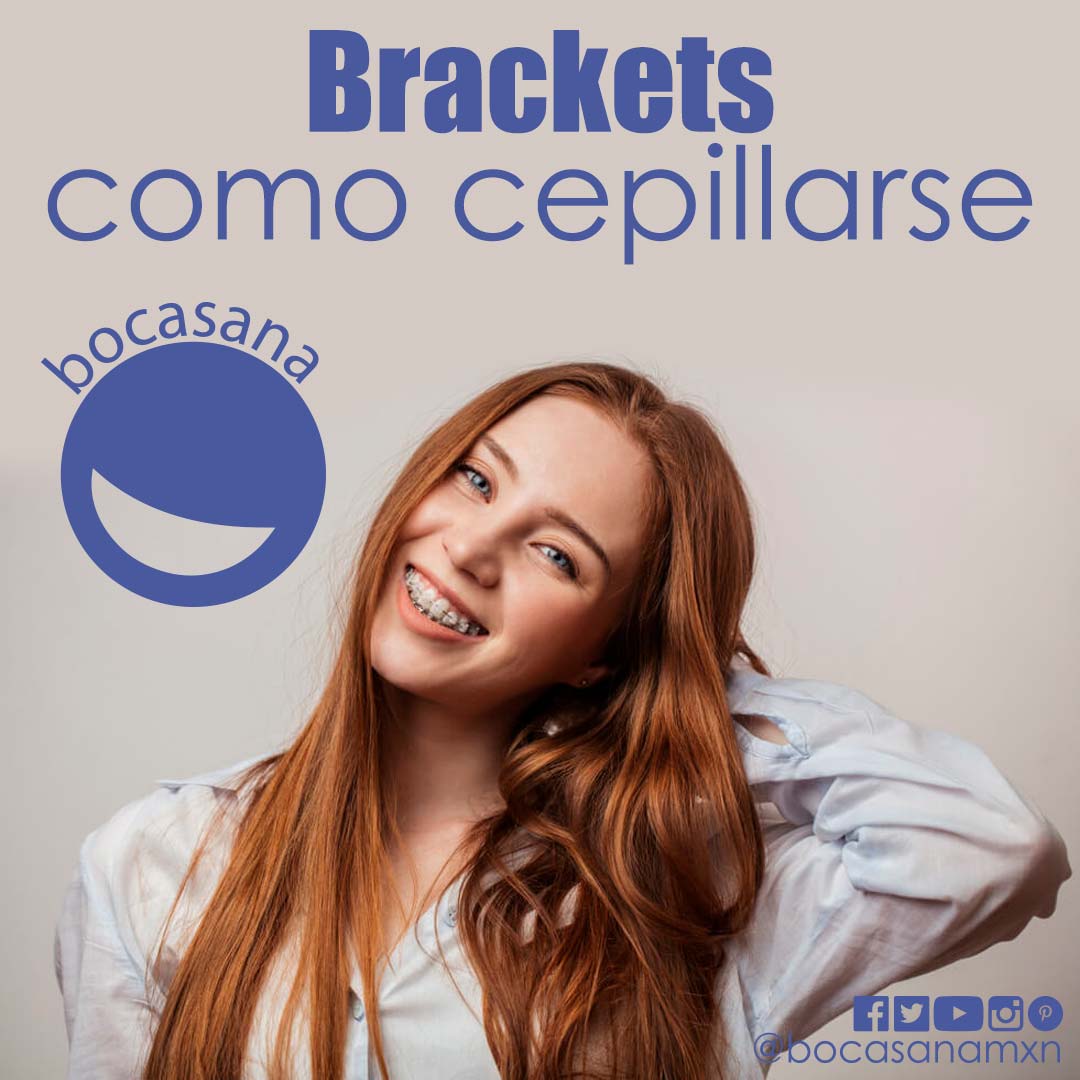 Brackets como cepillarse